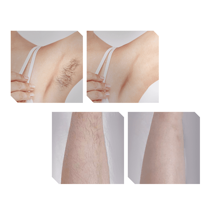 Lumeni Laser Diodowy Efekty Zabiegowe