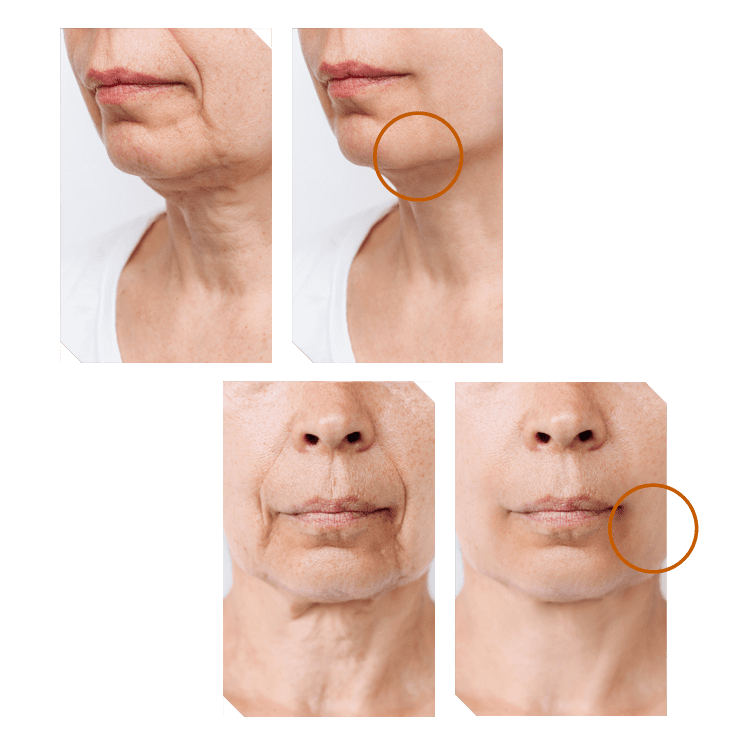 Rsfu Ultra 3d Rfsynchronized High Intensity Focused Ultrasound Efekty Zabiegowe